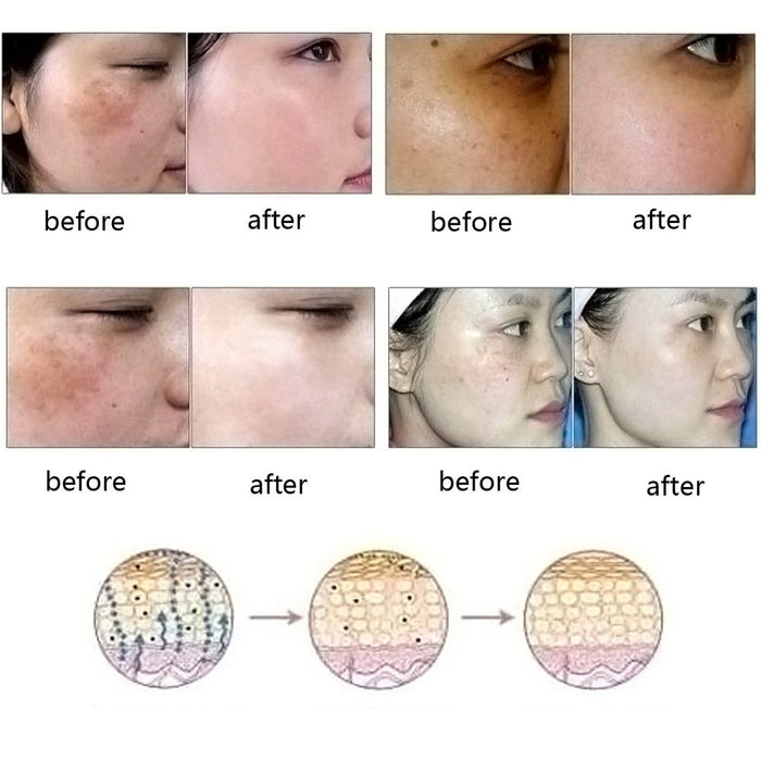 Dragado Meridian cuidado de la piel eliminación pura Natural acné estrías eliminación de cicatrices aceite de esencia